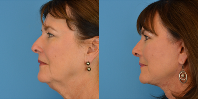 Facelift before and after photo