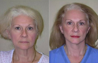 Facelift before and after photo