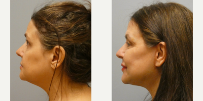 Facelift before and after photo