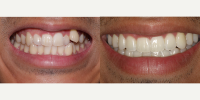 Invisalign before and after photo