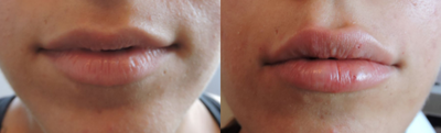 Juvederm before and after photo