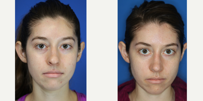 Rhinoplasty before and after photo
