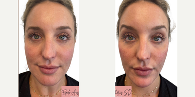 Cheek Fillers before and after photo