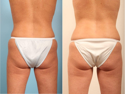 CoolSculpting before and after photo