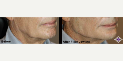 Dysport before and after photo