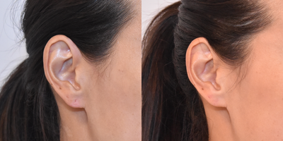 Earlobe Repair before and after photo