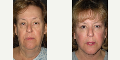 Facelift before and after photo