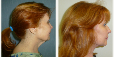 Facelift before and after photo