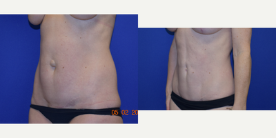 Mini Tummy Tuck before and after photo