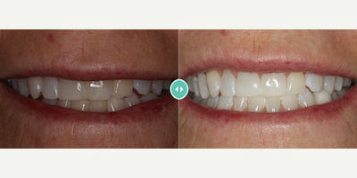 Teeth Whitening before and after photo