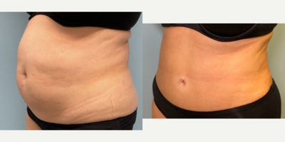 Tummy Tuck before and after photo