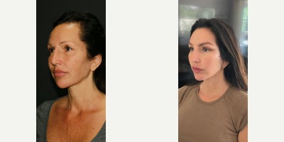 Deep Plane Facelift before and after photo