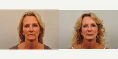 Facelift before and after photo
