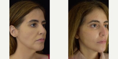 Facelift before and after photo