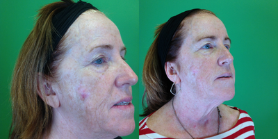 Fractora RF before and after photo