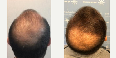 FUE Hair Transplant before and after photo