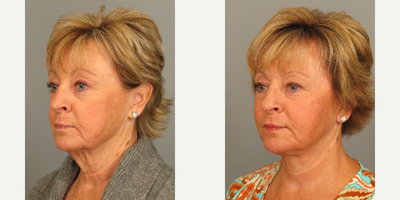 Neck Lift before and after photo