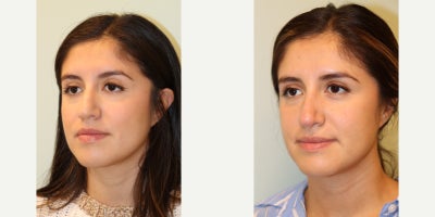 Rhinoplasty before and after photo