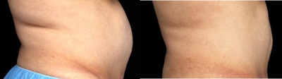 CoolSculpting before and after photo