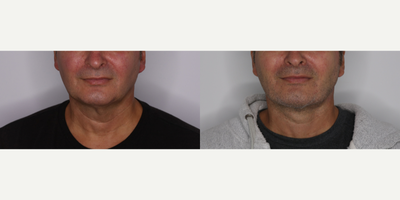 Neck Lift before and after photo