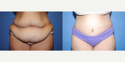 Tummy Tuck before and after photo