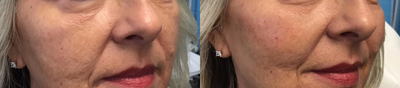 Voluma before and after photo