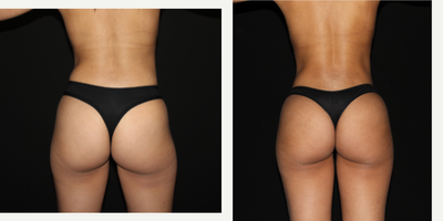 Brazilian Butt Lift before and after photo