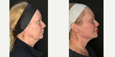 Dermal Fillers before and after photo