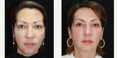 Facelift before and after photo