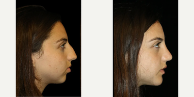 Genioplasty before and after photo