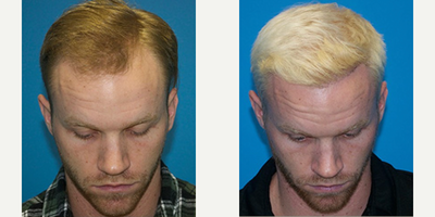Hair Transplant before and after photo