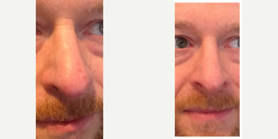 Laser Resurfacing before and after photo