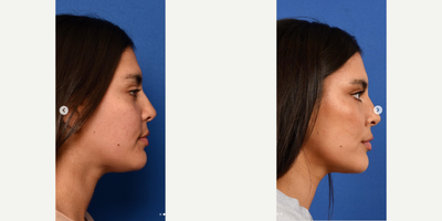 Lip Fillers before and after photo