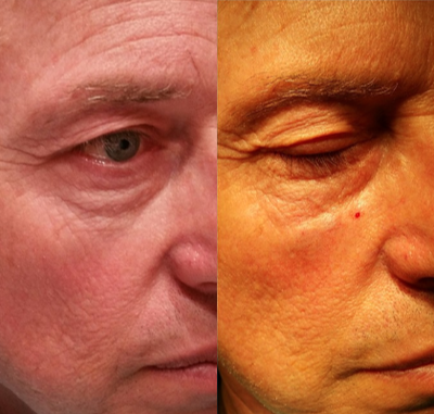 Belotero before and after photo