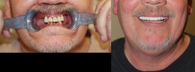 ClearChoice Dental Implants before and after photo