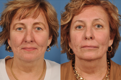 Facelift before and after photo