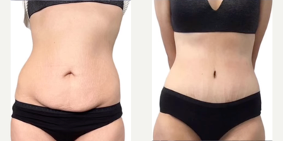 Liposuction before and after photo