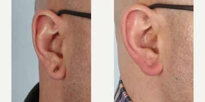 Earlobe Repair before and after photo
