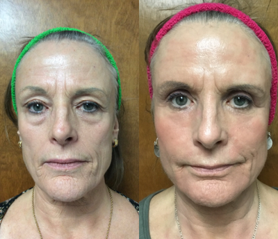 Eyelid Surgery before and after photo