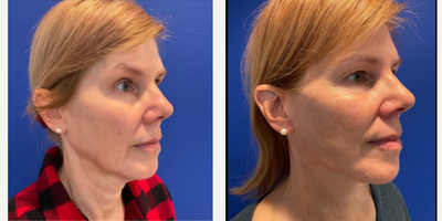Facelift before and after photo