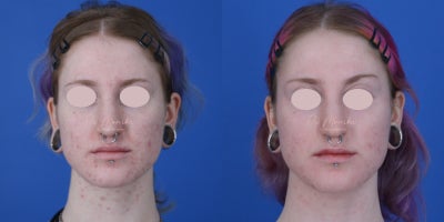 Accutane before and after photo