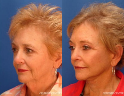 Facelift before and after photo