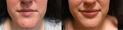Lip Fillers before and after photo