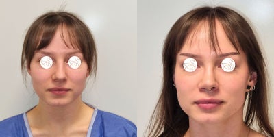 Rhinoplasty before and after photo