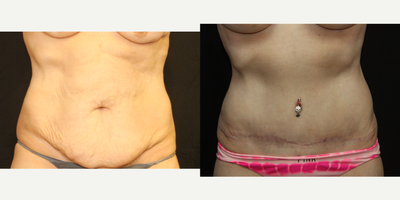 Tummy Tuck before and after photo