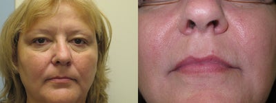 Juvederm before and after photo