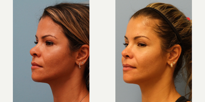 Revision Rhinoplasty before and after photo
