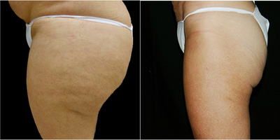 Body-Jet Liposuction before and after photo