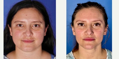 FaceTite before and after photo