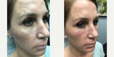 Juvederm before and after photo